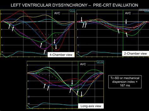 time to peak longitudinal strain